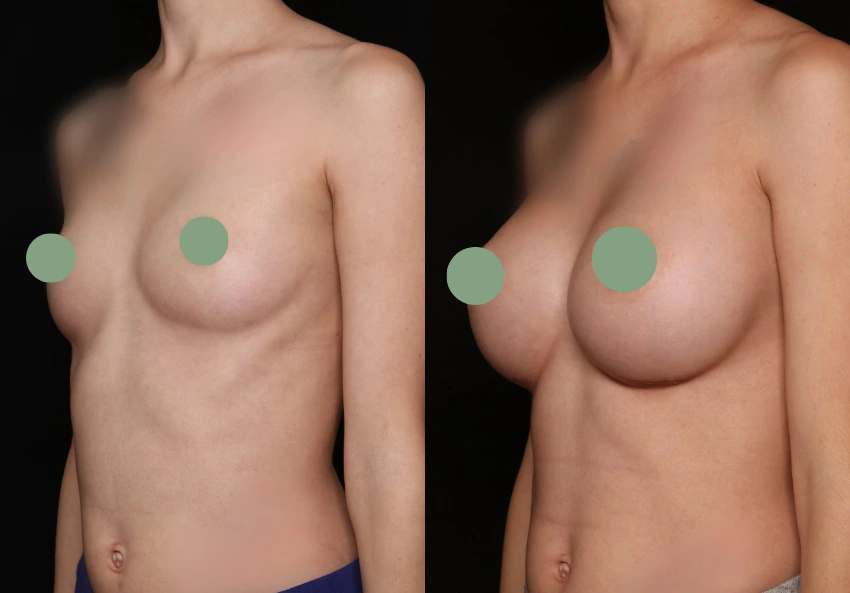 Breast Augmentation - Case 12 (1)