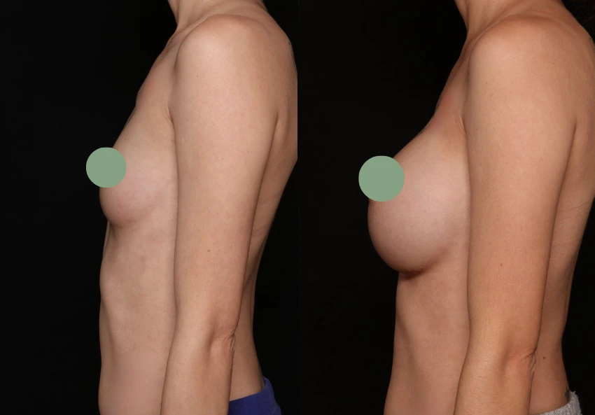 Breast Augmentation - Case 12 (3)